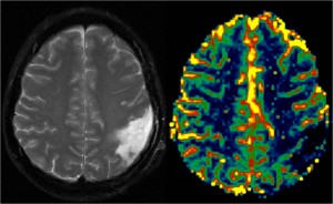 Radionecrosi (CBV – Cerebral Blood Volume)