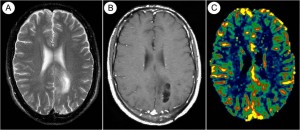 Tumore cerebrale (CBV – Cerebral Blood Volume)