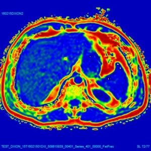 Liver Proton Density Fat-Fraction